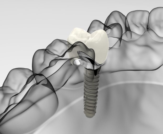 how-dental-implants-work